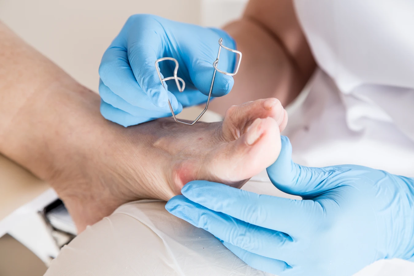 Bolący odcisk na małym palcu - jak sobie z nim poradzić?