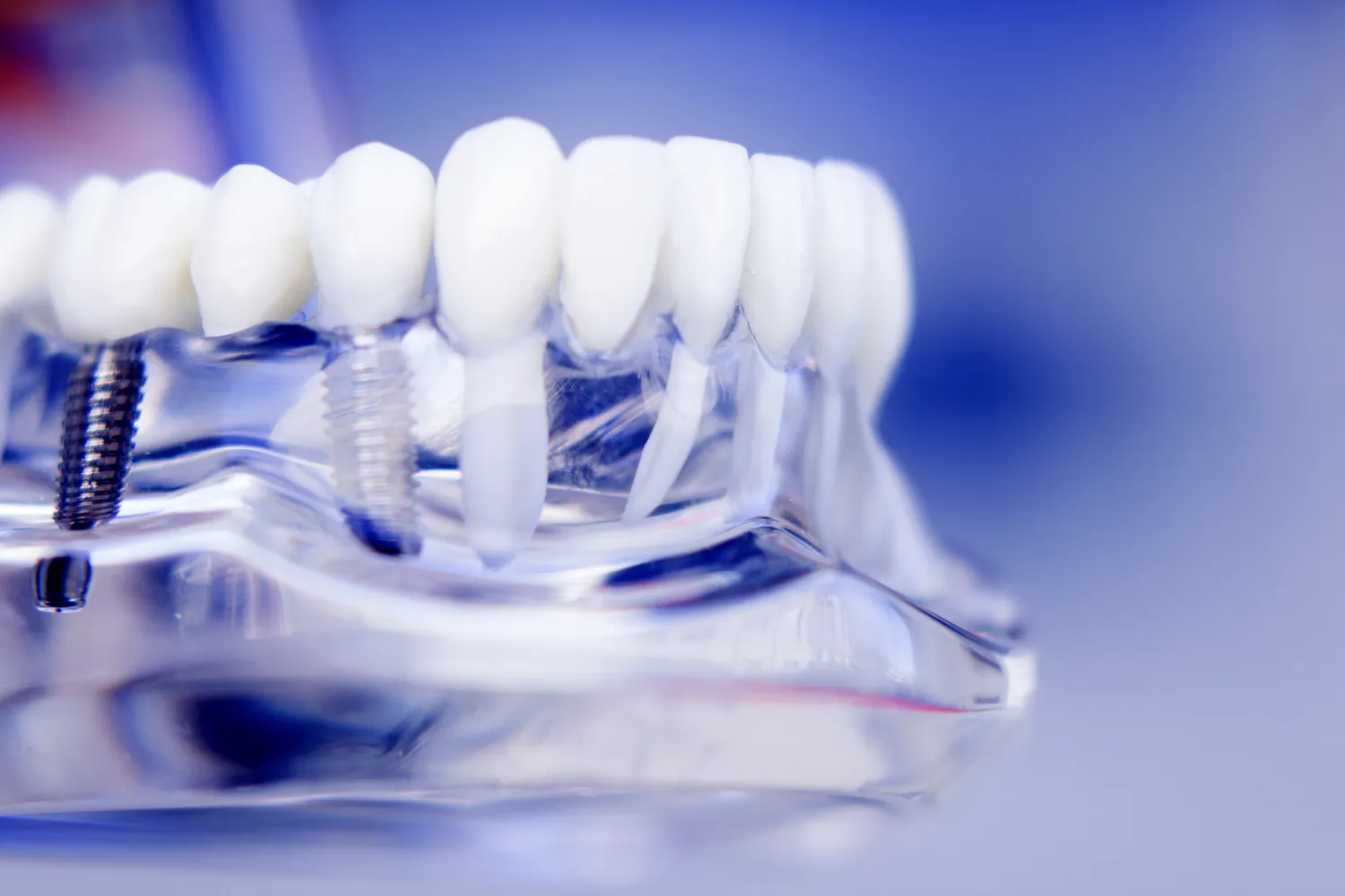 Dentysta Warszawa implanty